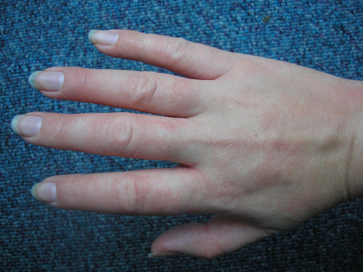 fingertips eczema